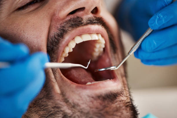 Best Emergency Tooth Extraction in Clinton, OH