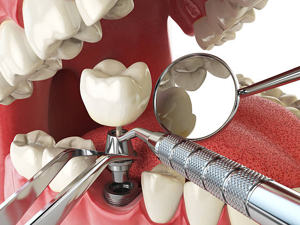 Best Emergency Root Canal Treatment in Clinton, OH